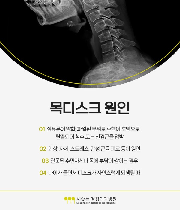 목디스크증상의 원인 네 가지 — 섬유륜이 약화되거나 파열된 부위로 수핵이 후방으로 탈출되어 척수 또는 신경근을 압박, 외상과 자세와 스트레스와 만성 근육 피로, 잘못된 수면자세나 목에 부담이 쌓이는 경우, 나이가 들면서 디스크가 자연스럽게 퇴행될 때를 설명하는 경추 엑스레이 이미지